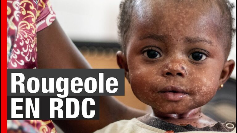 RDC : plus de 148 000 cas de rougeole enregistrés depuis le début de l’année